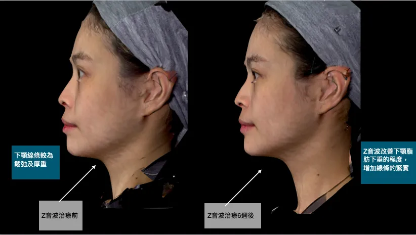 【醫美】2024最新無痛音波 韓國女神李英愛推薦 Linea
